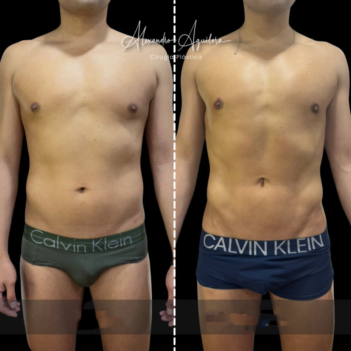 Before and after 360 liposuction results at Dr. Alexandro Aguilera - Plastic Surgery, male torso