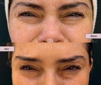 Результат ботокса лба до и после в клинике Perfect Skin — гладкая кожа