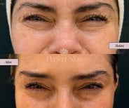 Результат ботокса лба до и после в клинике Perfect Skin — гладкая кожа