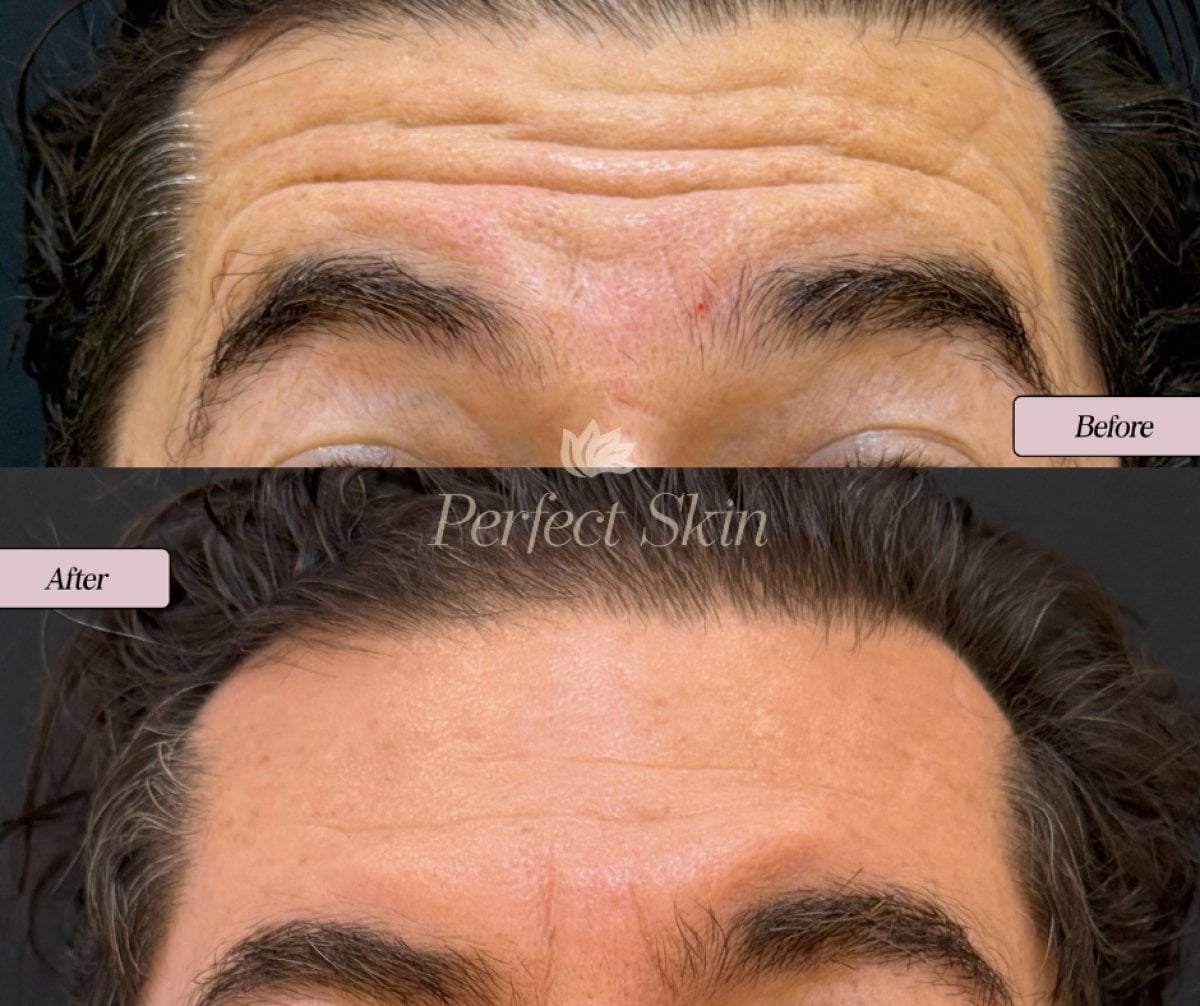 نتائج البوتوكس للجبهة قبل وبعد في عيادة Perfect Skin – جبهة ناعمة وخالية من التجاعيد