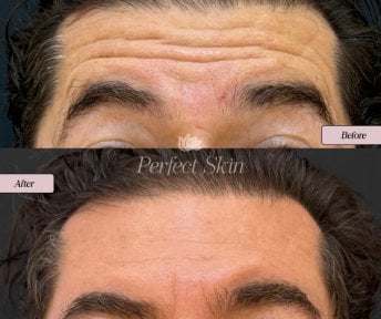 Результат ботокса лба до и после в клинике Perfect Skin – гладкая кожа без морщин