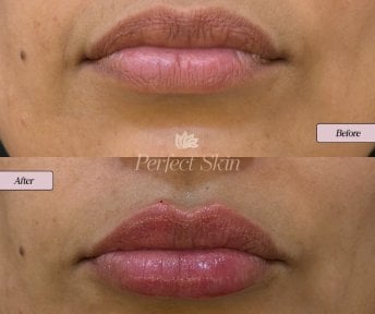 Before and after lip fillers injection at Perfect Skin clinic – enhanced lip volume result