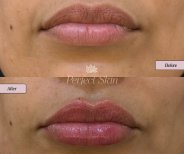 Resultado antes y después de relleno de labios con ácido hialurónico en Perfect Skin