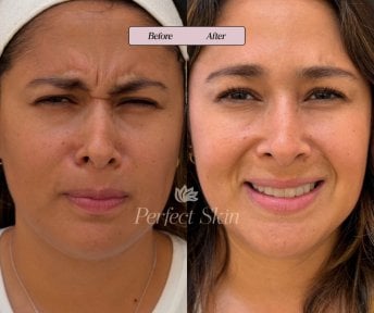 Before and after Botox injections at Perfect Skin clinic, reduced forehead wrinkles result