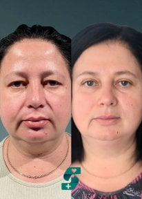 نتائج رأب الجفن قبل وبعد في Soraca Med – تصحيح الجفون لمظهر أكثر شبابًا