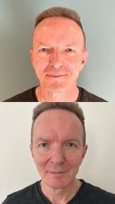 نتائج رأب الجفن قبل وبعد في Soraca Med، تحسن واضح في تصحيح الجفون