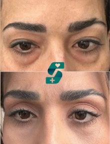 نتائج رأب الجفن قبل وبعد في Soraca Med – تصحيح الجفون لمظهر أكثر انتعاشًا