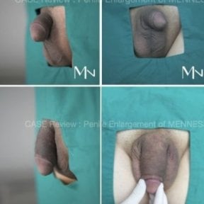 Before and after penis enlargement results at Menness Wellness Clinic, visible size improvement