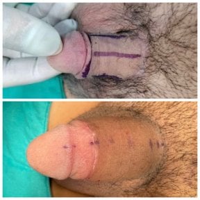 Before and after penis enlargement results at Menness Wellness Clinic, visible size increase