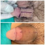 Before and after penis enlargement results at Menness Wellness Clinic, visible size increase