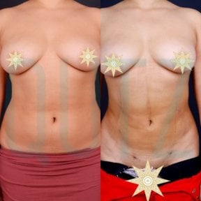Before and after liposuction results at Quartz Hospital, visible waist and abdomen contouring