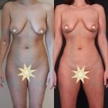 Before and after liposuction results at Quartz Hospital, visible body contour improvement