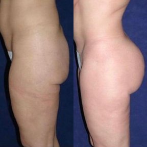 Before and after Brazilian Butt Lift results at Private Yüzyıl Hospital, enhanced buttock contour
