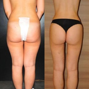 Before and after Brazilian Butt Lift results at Private Yüzyıl Hospital, enhanced contour