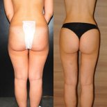 Before and after Brazilian Butt Lift results at Private Yüzyıl Hospital, enhanced contour