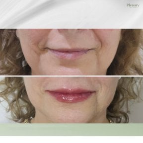 Avant et après injections de Botox chez Plenary Wellness, amélioration visible des lèvres et rides