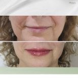 Avant et après injections de Botox chez Plenary Wellness, amélioration visible des lèvres et rides
