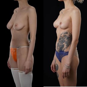 Before and after breast reduction results at Yurchenko Plastic Surgery Team, improved contour