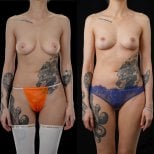 Фото до та після зменшення грудей, доктор 