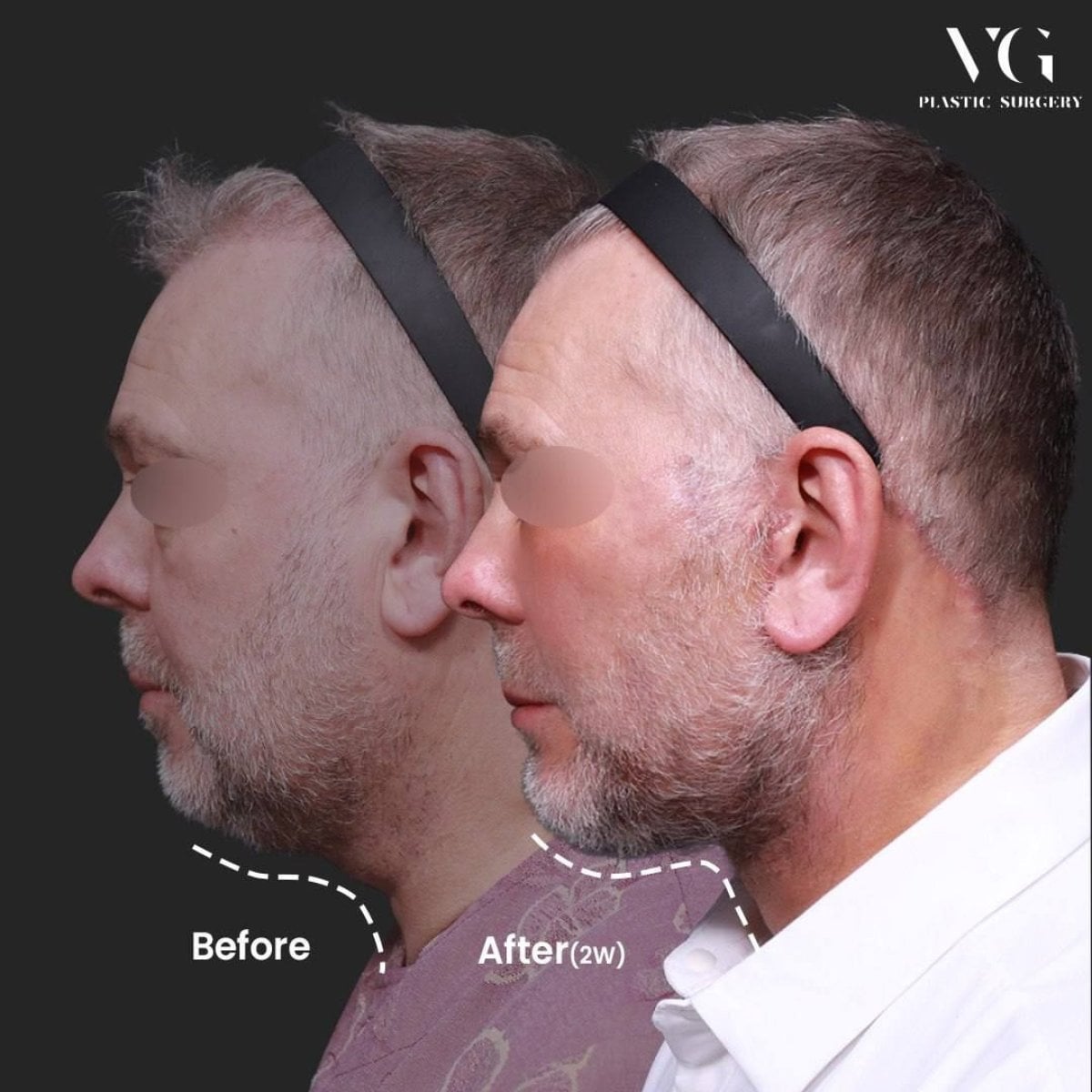 Resultados de lifting facial antes y después en VG Plastic Surgery, mejor contorno mandibular
