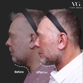 Facelift Vorher-Nachher-Ergebnis bei VG Plastic Surgery, verbesserte Kiefer- und Halspartie