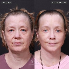 Vorher-nachher-Ergebnis endoskopisches Facelift bei VG Plastic Surgery, sichtbare Verjüngung