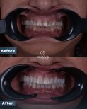 Résultats avant et après Hollywood Smile à Dentavie Istanbul Dental Clinic, dents blanches
