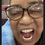 All-on-6 dental implants result at Love Dental and Sthetic Clinic, improved smile appearance