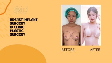 Before and after breast augmentation results at ID Clinic Bangkok, natural enhancement visible