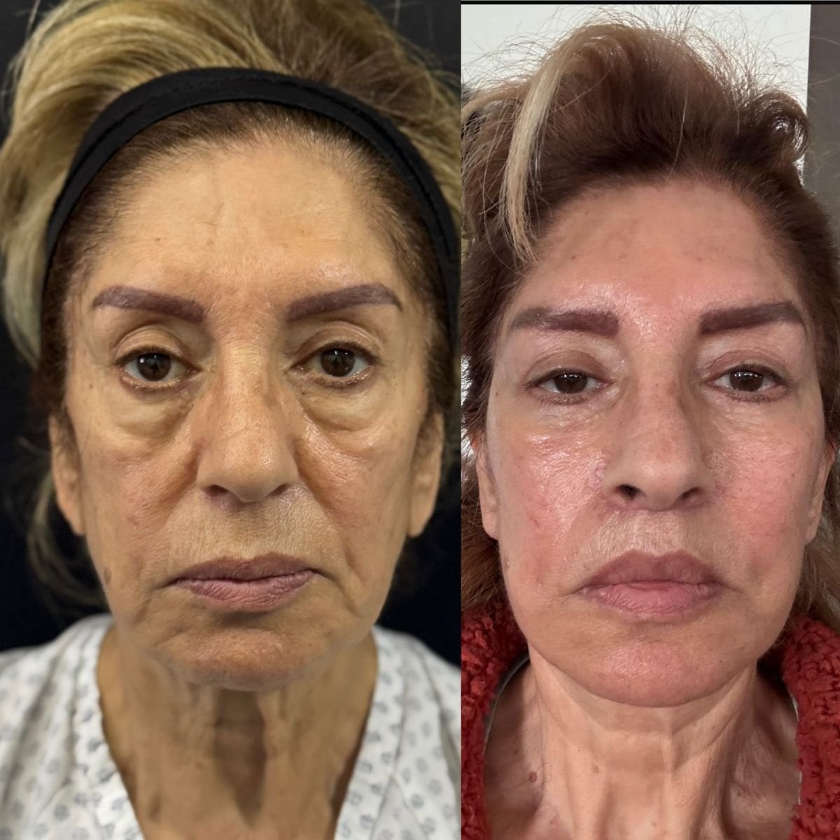 نتائج شد الوجه العميق قبل وبعد في عيادة ماروكين و ساندوفال للجراحة التجميلية