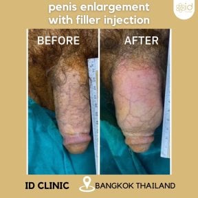 Before and after penis filler injection results at ID Clinic Bangkok for penis enlargement