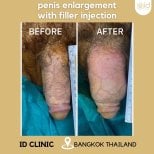 Before and after penis filler injection results at ID Clinic Bangkok for penis enlargement