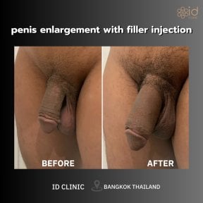 Before and after penis filler results at ID Clinic Bangkok – visible enlargement and enhancement