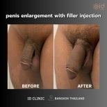 Before and after penis filler results at ID Clinic Bangkok – visible enlargement and enhancement