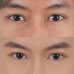 Before and after lower eyelid blepharoplasty results at Lelux Hospital, reduced under-eye bags