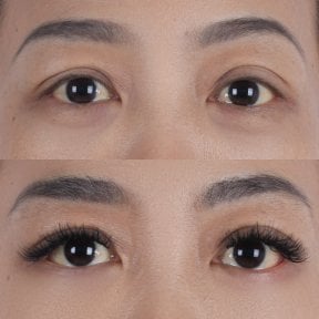 Before and after lower eyelid blepharoplasty results at Lelux Hospital, under-eye rejuvenation