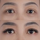 Before and after lower eyelid blepharoplasty results at Lelux Hospital, under-eye rejuvenation