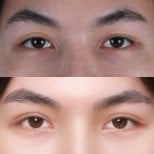Before and after lower eyelid blepharoplasty results at Lelux Hospital, eye rejuvenation