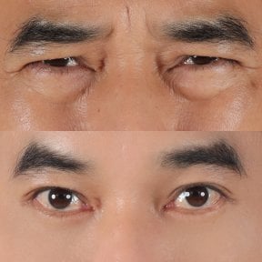 Before and after lower eyelid blepharoplasty results at Lelux Hospital, reduced eye bags