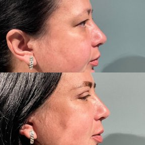 Before and after upper and lower eyelid surgery results at Soraca Med Istanbul, rejuvenated look