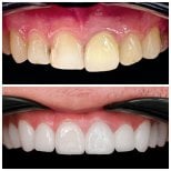 Результаты до и после Hollywood Smile в Soraca Med – виниры для белых зубов