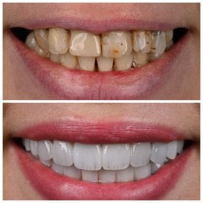 Before and after Hollywood Smile results at Soraca Med – dental veneers for whiter teeth