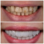 Before and after Hollywood Smile results at Soraca Med – dental veneers for whiter teeth