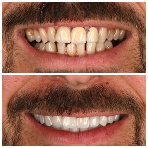 Résultats Hollywood Smile avant/après chez Soraca Med – dents plus blanches et régulières
