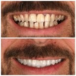 Résultats Hollywood Smile avant/après chez Soraca Med – dents plus blanches et régulières