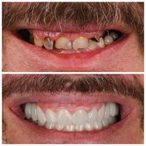Résultats avant et après Hollywood Smile chez Soraca Med – transformation complète du sourire