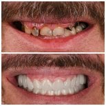 Résultats avant et après Hollywood Smile chez Soraca Med – transformation complète du sourire