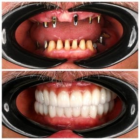 Efekty przed i po implantach zębów w Soraca Med – pełna odbudowa uśmiechu