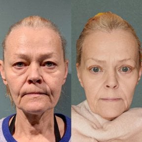 Résultats avant et après blépharoplastie chez Soraca Med, correction des paupières rajeunissante