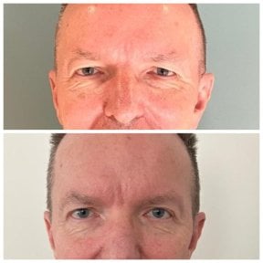 Résultats avant et après blépharoplastie chez Soraca Med, correction des paupières rajeunissante